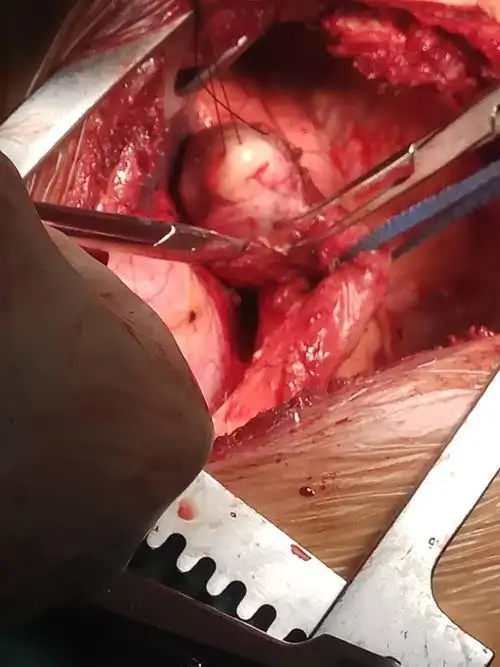 食管平滑肌瘤 - 好大夫在线