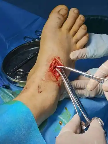 足背动脉,肌腱损伤