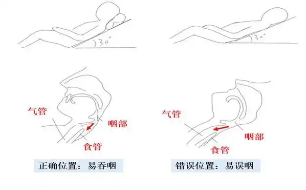 科普沉默杀手吸入性肺炎我们要怎么对付它