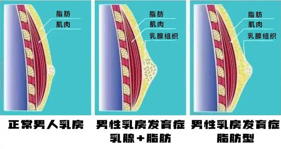 男性乳房肥大,仅靠吸脂就能改善吗?