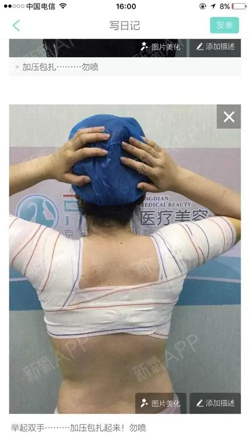 《长春京典医疗美容—张院长—腋臭手术术后6天》腋臭_圈子-新氧美容