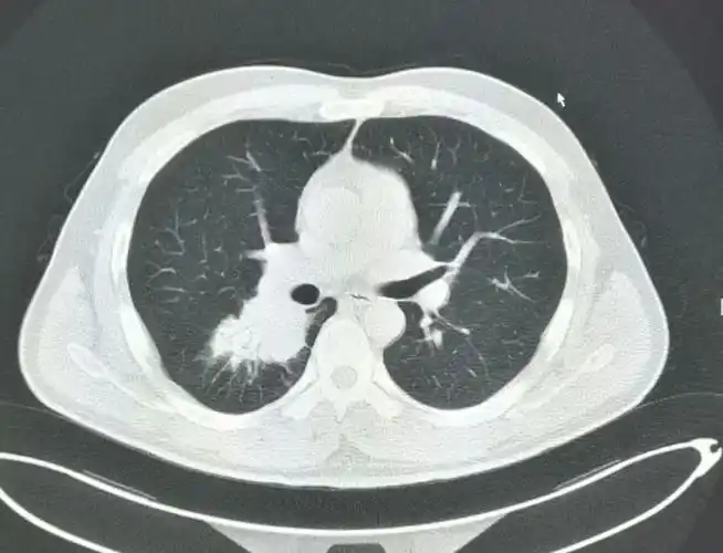 右侧中心型肺癌,右肺切除术后两年,术后残腔?——中心医院病例库