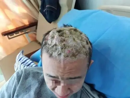 少年头长满难看的蝼蛄疖 医生提醒:皮肤痤疮应及早治疗