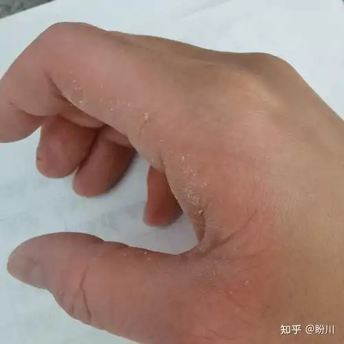 掌跖角化症有没有人成年以后慢慢缓解了的? - 知乎