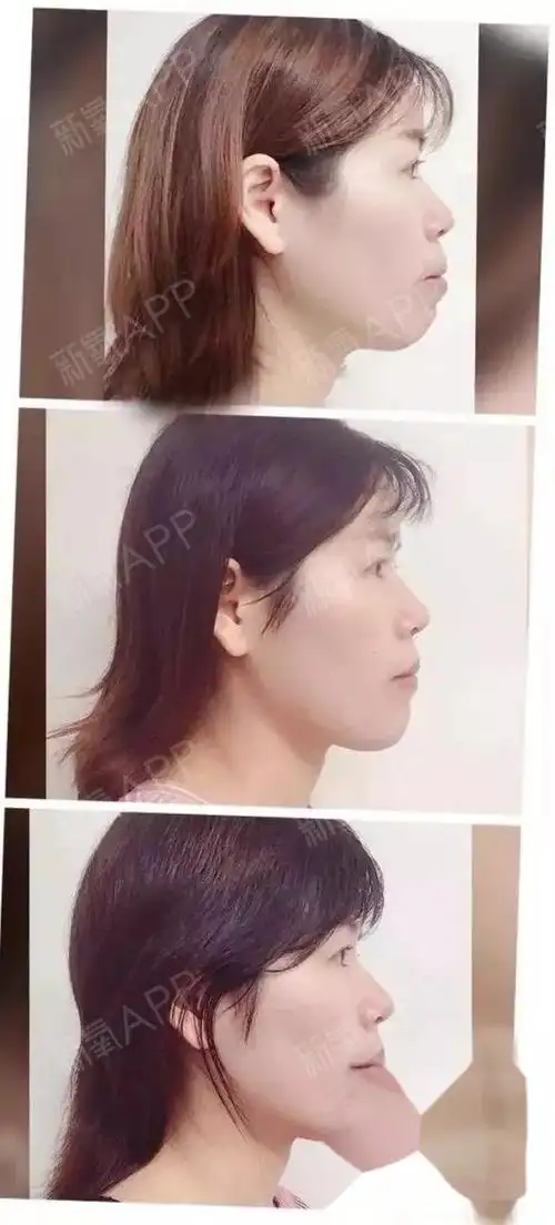 牙套中侧脸对比