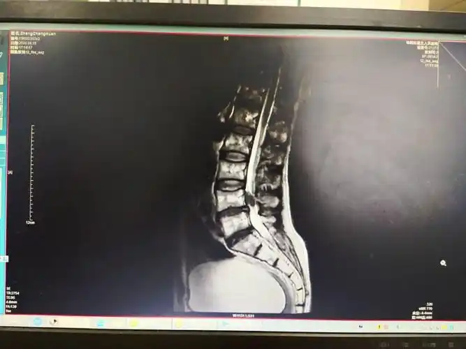 我院腰椎mri示:腰45椎间盘脱出,腰4椎体后缘有一脱出的髓核.