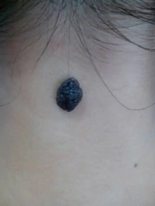 我脖子后中间长有一颗黑痣凸起,有花生米大小,出生时很小一点点,随着