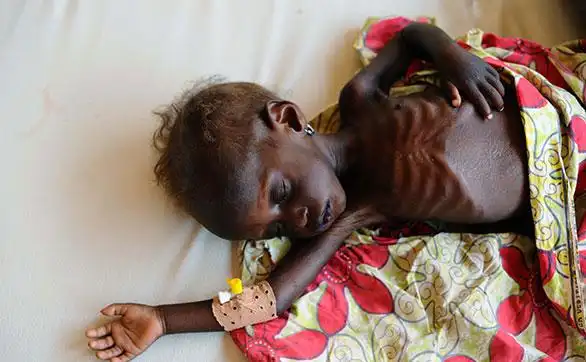 非洲大饥荒,孩子瘦成皮包骨,40万儿童面临断粮