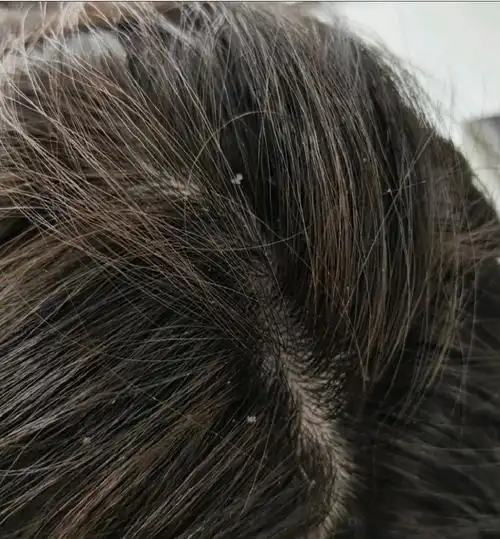 头屑去无踪,养出健康头皮