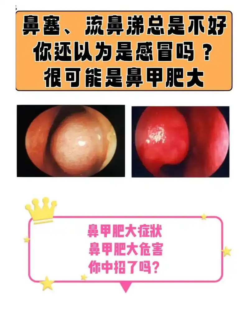 不要再把鼻甲肥大当感冒了