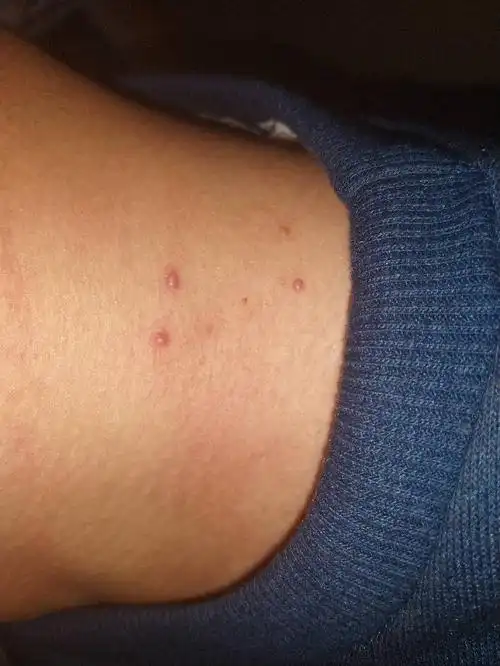 最近艾滋病宣传闹的厉害,不知道是不是淋巴结肿大 答题抽奖 首次