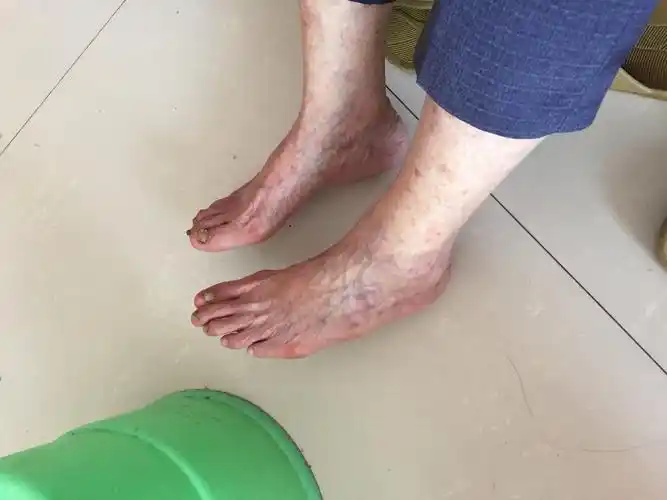 我奶奶 年纪80多岁了,双脚发紫有点静脉曲张的感觉,总是会麻痹 疼痛