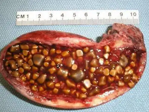 胆囊结石与多种因素有关.