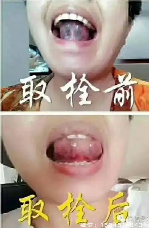 舌下取栓――重启生命之脉