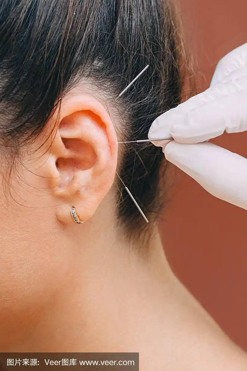 耳针治疗多种疾病.