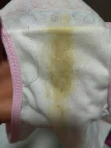 这种白带是属于什么原因引起的?