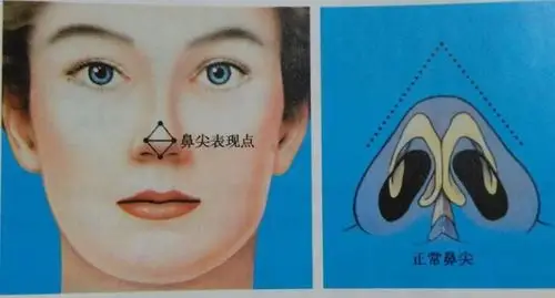 我觉得我的鼻头很大,鼻梁和山根都挺满_新氧美容整形