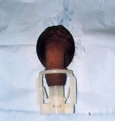 几例环扎压榨型包皮环切术