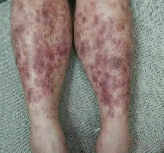 治疗前.双下肢皮下出血.