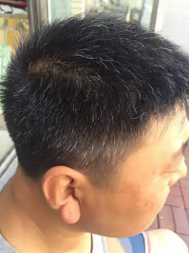 17岁长白头发怎么回事?