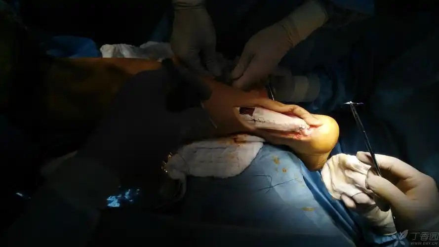 止点性跟腱炎并断裂,病灶切除并踇长屈肌重建跟腱手术一例 [病例帖]