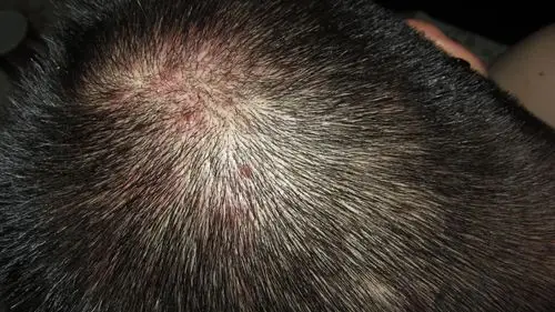 求妙手治疗穿凿性毛囊炎 - 皮肤及性传播疾病讨论版 - 爱爱医医学论坛