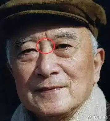 横纹建议警惕心血管方面的疾病逐渐出现1~3条横纹如果山根偏上的地方