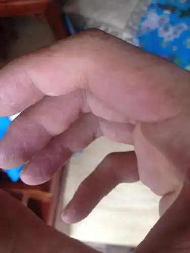 医师助理 我好像得了湿疹,结果看了几次都反复发作长这种小水泡