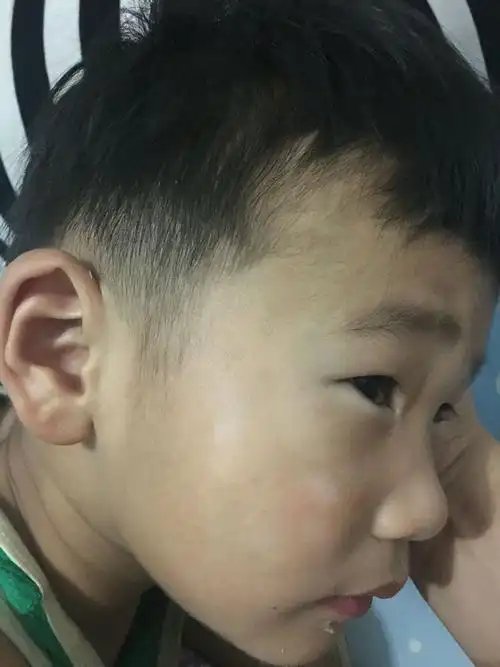 孩子脸上一块白一块白的!不知道是癣还是肚子里面有虫