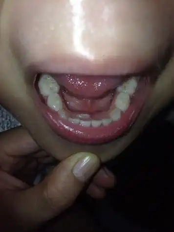 五岁的小女孩,怎么会在牙齿后面又长一颗牙齿?