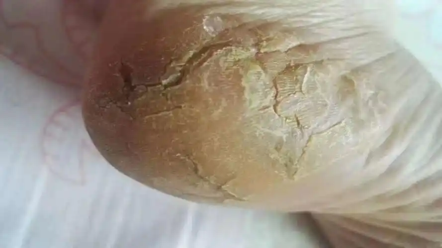 创面专家!脚干裂轻松治愈!
