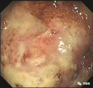 痛心老汉查出胃溃疡2年不治不查癌变了