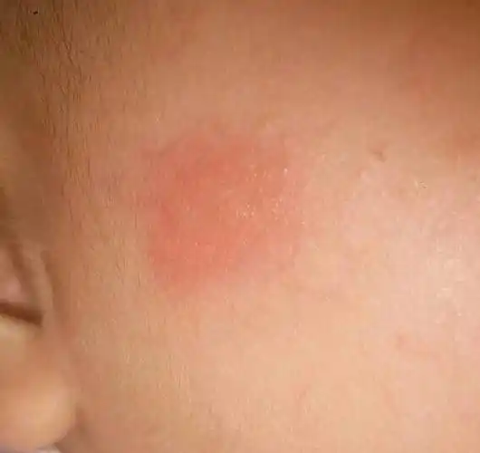 问:宝宝脸上和身上突然出现这样的红斑,是过敏还是湿热啊?还是?