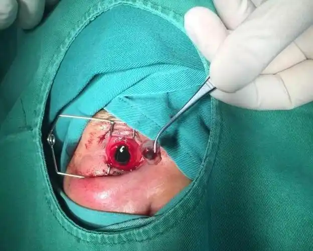 角膜)沙莎主任介绍,随着老年社会的到来,多数老年人都有睑内翻或倒睫