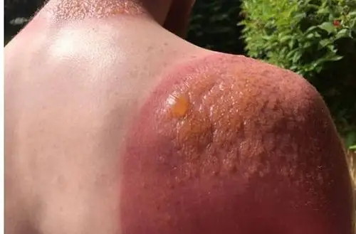 夏日户外活动一定要防晒,多图预警暴晒二级烧伤,惨不忍睹