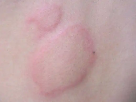 荨麻疹到底会不会传染呢