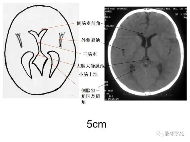 基底节区结构基底节(basal ganglia)(又称基底神经节)是指从胚胎端脑