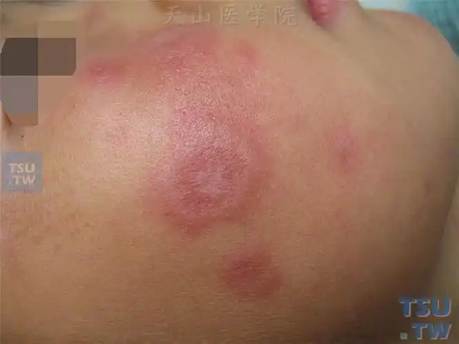 亚急性皮肤型红斑狼疮(scle)的症状表现