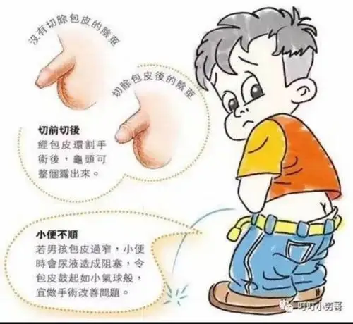 包皮过长,包茎容易使婚后女性患阴道炎,糜烂等妇科疾病