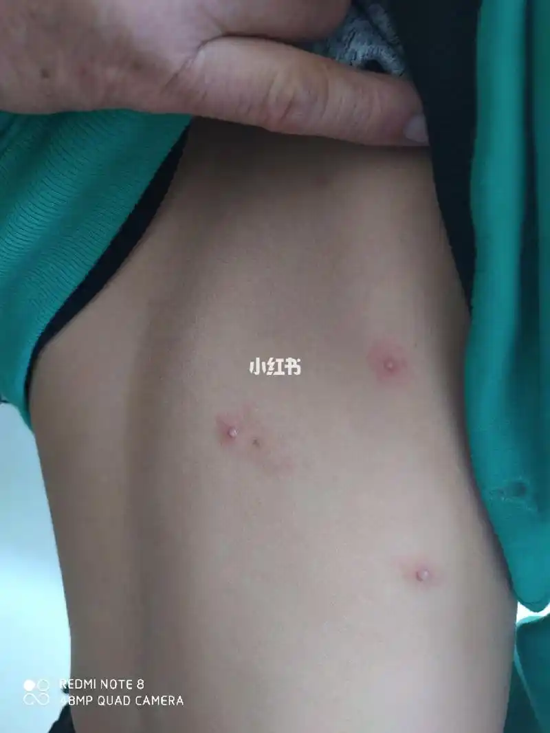 传染性软疣,很典型的,一般好发于儿童!