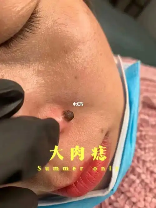 痣尚馆肉痣三个月_美妆_医美_整容_美妆_医美整形