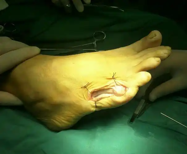 小趾内翻畸形伴跖骨头滑囊炎