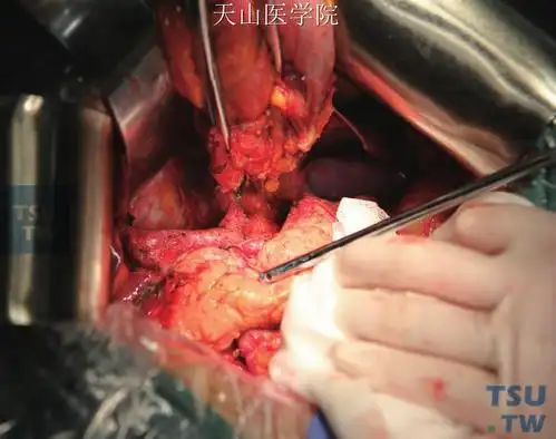 胃癌根治性远端胃大部切除术