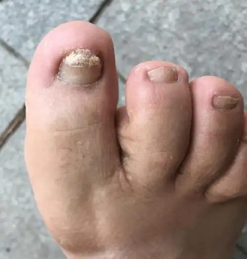 医院都不说的灰指甲治愈妙招!学会一个也能终身受益!速看!