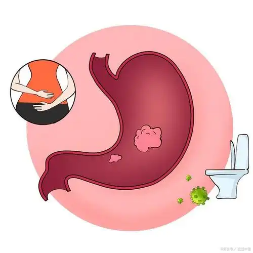 腹泻恶心呕吐1天急性胃肠炎要注意什么该怎么治疗