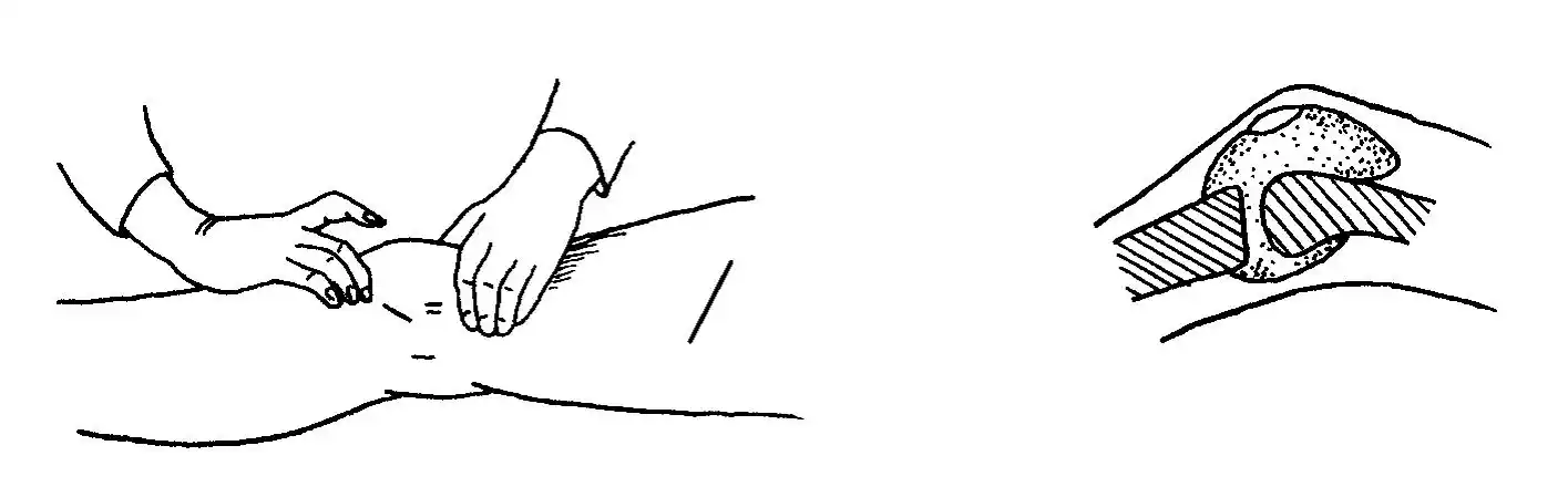 图4-40 浮髌试验5.