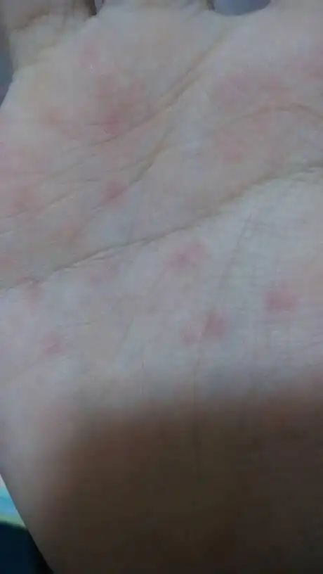 手掌心有几个红点,不痛不痒,这是怎么回事