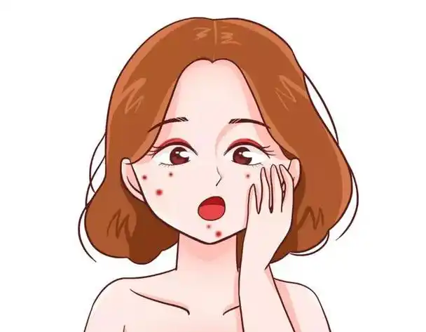 痘痘反复总不好?科学治疗是关键!