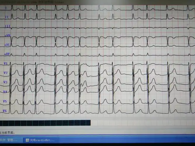 原先房颤心律,里面有很多段pr长短不一的片段 - 心电图脑电图专业讨论