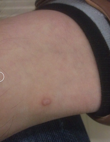 脚踝后有一个肉痣好几年了不知道是啥